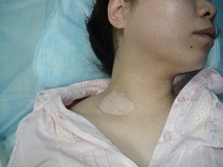 胸部白癜风危害.jpg