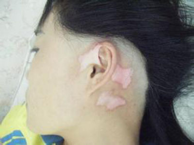 怎么能预防面部白癜风呢.jpg